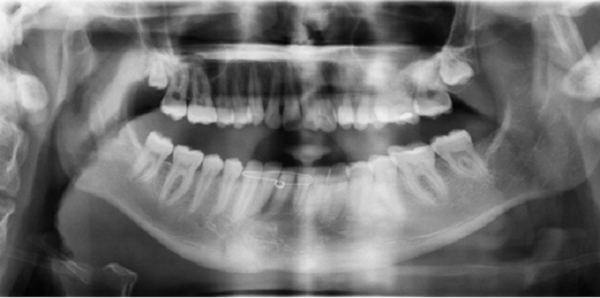 Hình chụp CT của bệnh nhân H.D.R trước khi phẫu thuật (Ảnh FV)