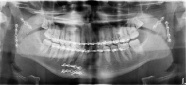 Hình chụp CT sau phẫu thuật của bệnh nhân H.D.R (Ảnh FV)