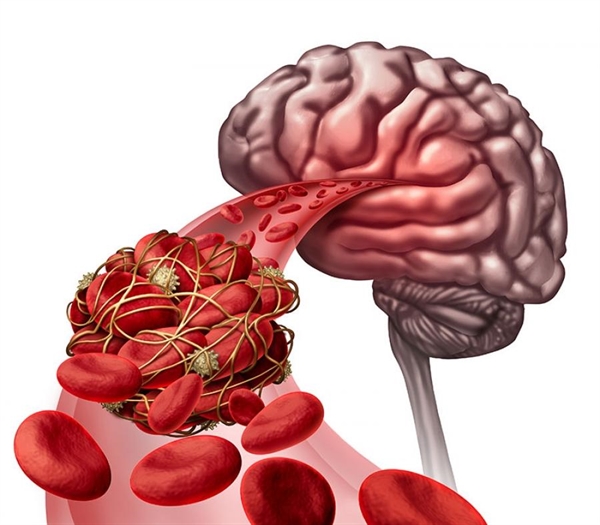 Cục máu đông hình thành trên não hoặc “chạy” lên não có thể đưa đến đột quỵ. Ảnh minh họa.
