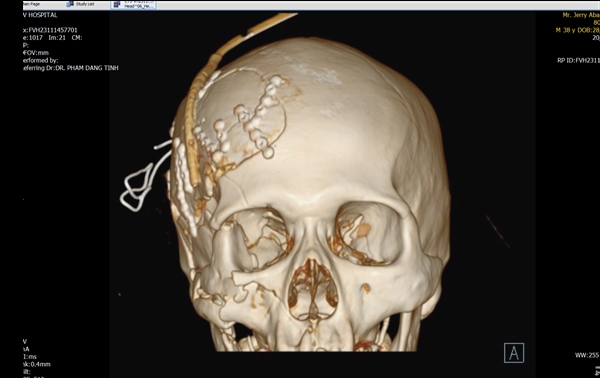 Hình chụp Cone Beam CT 3 chiều cho thấy bệnh phần xương mặt bị vỡ nát