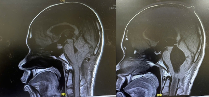 Hình ảnh MRI cho thấy hạnh nhân tiểu não tụt xuống C1 và rỗng tủy kéo dài đến D9 (bên trái) và sau khi phẫu thuật tình trạng được cải thiện rõ rệt (bên phải)